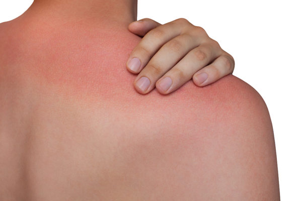 A man with reddened, itchy skin after sunburn on white isolated background. Skin care and protection from the sun's ultraviolet rays.